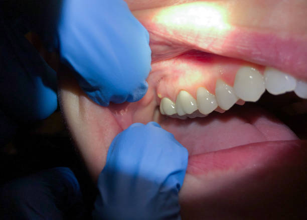 Best Knocked-Out Tooth (Avulsed Tooth) Treatment in Nora Springs, IA
